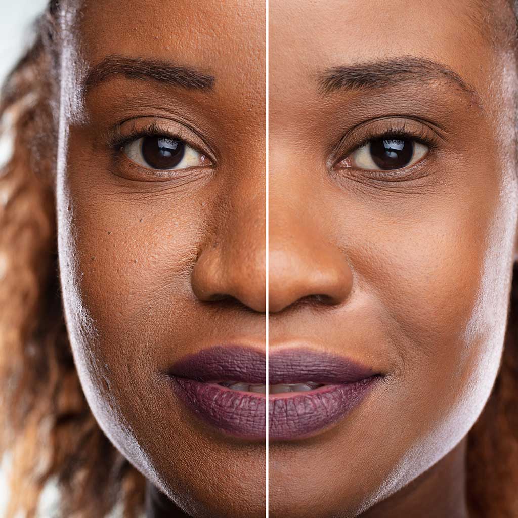 Vorher-Nachher Gesichtsbild einer Frau nach erfolgter Microdermabrasion-Behandlung
